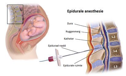 epidurale anesthesie