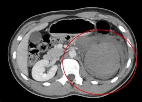 ct-scan van verwondingen aan een nier