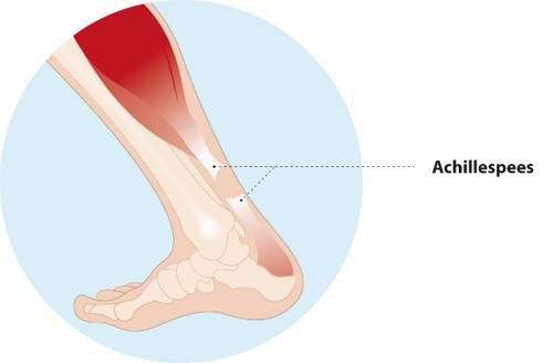 achillespeesruptuur