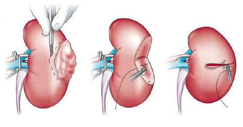 Laparoscopische (partiële) verwijdering van de nier