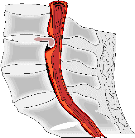 hernia